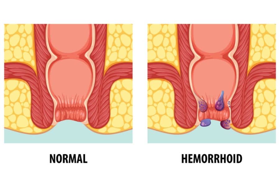 Hemorrhoid Grades Understanding the Levels, Symptoms, and Natural Ayurvedic Solutions (1)