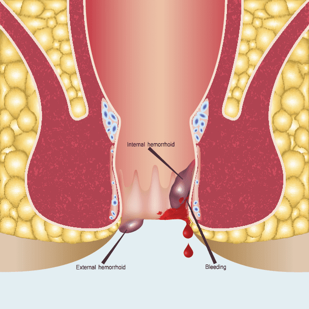 internal hemorrhoid blood illustration